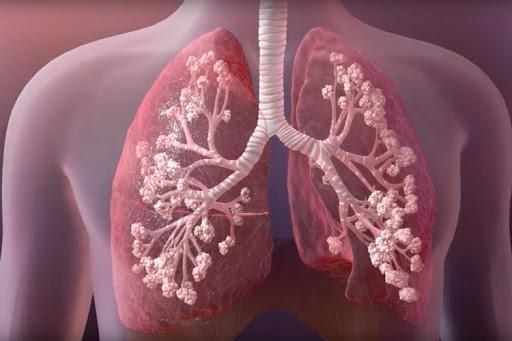 Cystic Fibrosis (CF): Causes, Symptoms, Diagnosis & Treatment